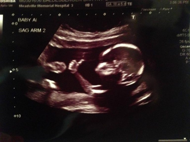 Niente aborto per la bambina violentata. Onu accusa il Paraguay di negare «i servizi salva vita»