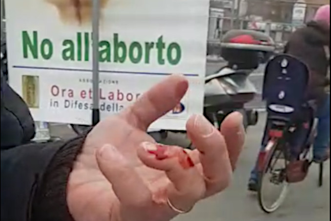 La mano ferita di uno dei manifestanti anti aborto davanti all'ospedale San Gerardo di Monza