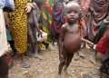 Bambino malnutrito, Kenya