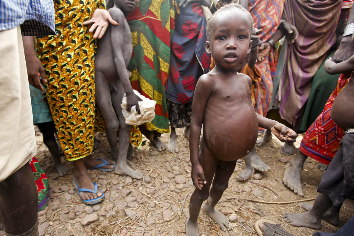 Bambino malnutrito, Kenya