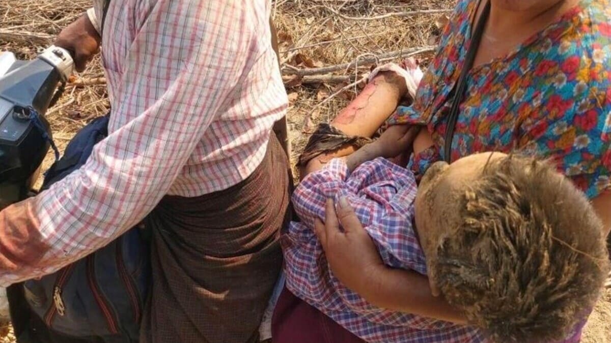 Un bambino rimasto ferito dopo l'attacco del regime al villaggio di Pazigyi